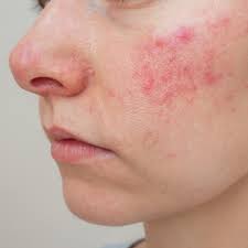 ROSACEA